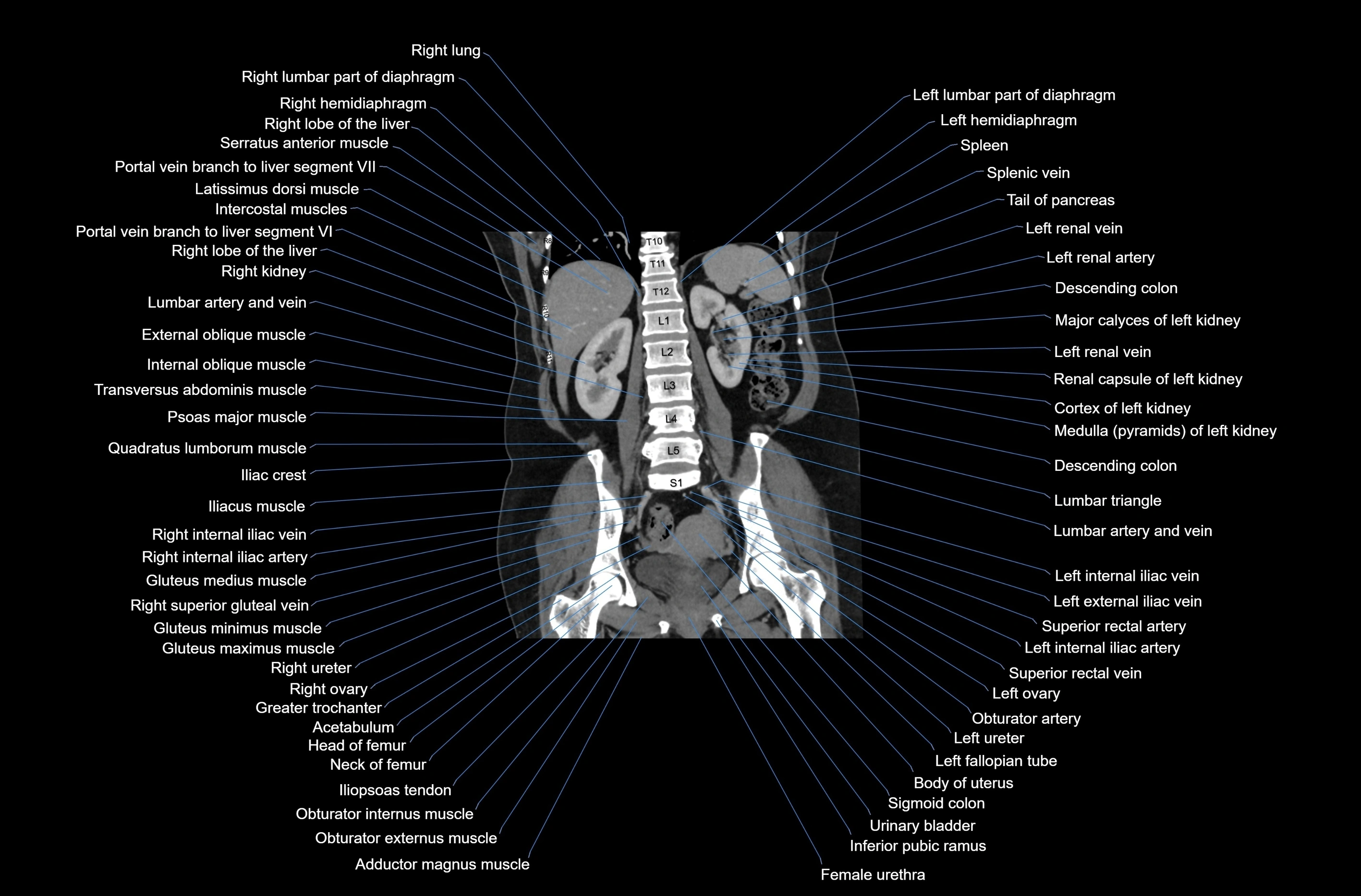 CT abdomen coronal cross sectional anatomy labelled radiology image-00057.webp